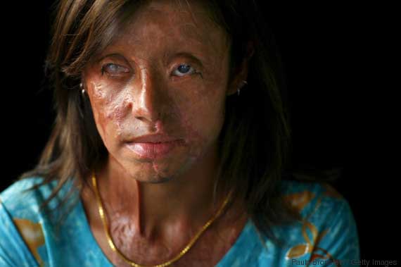 PAK: Acid Violence Against Women in Pakistan