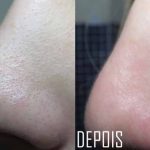 Em uma cara manchas ásperas escuras