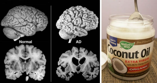 How-to-Treat-Alzheimer’s-Starting-with-3-Teaspoons-of-Coconut-Oil-Per-Day