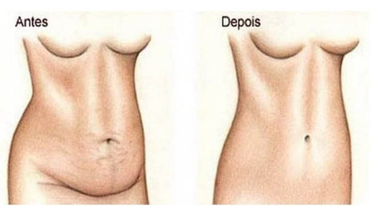 secar_barriga