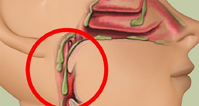 rinite_e_sinusite_-_cloreto_de_magnesio